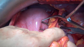 Gastric resection