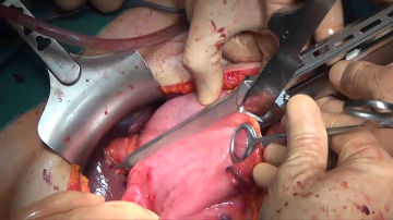 Transecting the duodenum