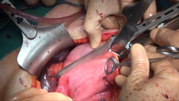 Transecting the duodenum
