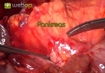 Taking down adhesions with the pancreas and removing the specimen