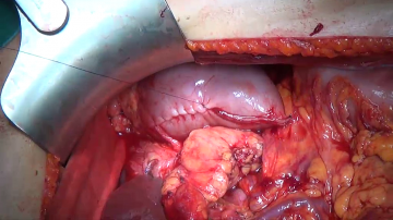 Closing the mesocolic window, Lembert sutures of the staple lines