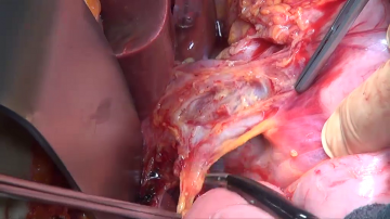 Lymphadenectomy I (hepatoduodenal ligament/LN stations 12 and 13)