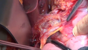 Lymphadenectomy I (hepatoduodenal ligament/LN stations 12 and 13)