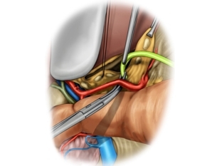 Lymphadenectomy II (common hepatic artery/station 8)