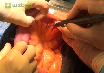 Formation of the Roux-Y Loop