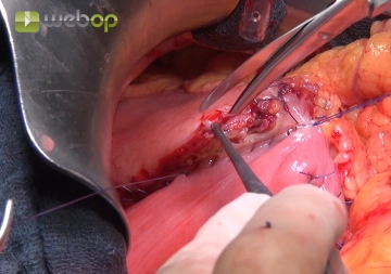 Gastrojejunostomy β Posterior Wall Suture