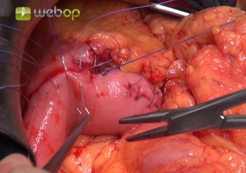 Gastrojejunostomy β Anterior Wall Suture