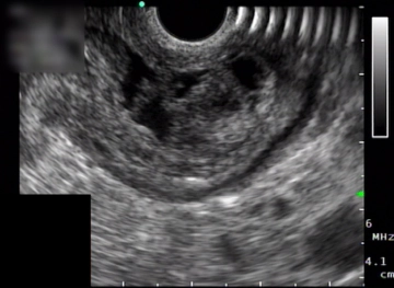 Laparoscopia exploratoria