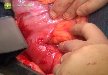 Cambio a una laparotomía