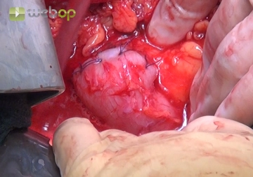 Sobrecostura del muñón duodenal