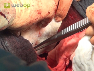 Closing the diaphragm and sealing the liver