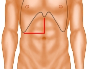 Laparotomy and exploration