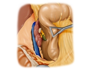 Kocher maneuver mobilizing the duodenum