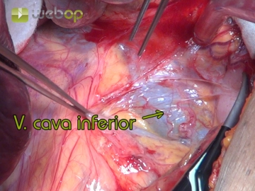 Exposing the right retroperitoneum and mobilizing the liver