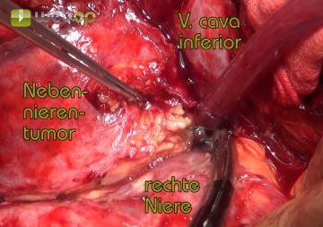 Separating right adrenal and kidney