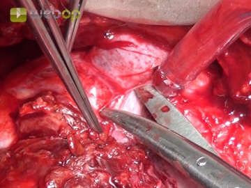 Transecting the adrenal vein