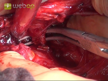 Posterocaval dissection of the adrenal tumor