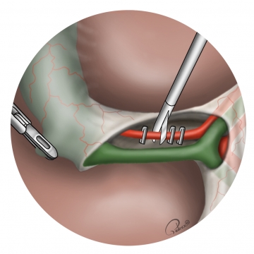 Clipping and transecting the cystic artery