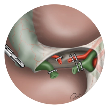 Clipping of the cystic duct and transection