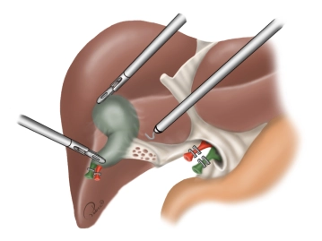 Retrograde mobilization of the gallbladder