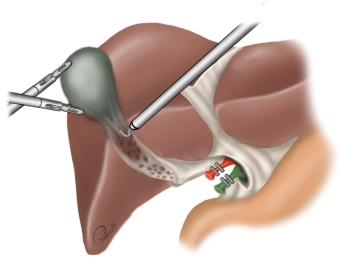 Hemostasis of the gallbladder bed
