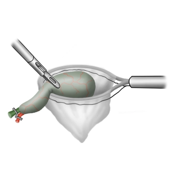 Extraction of the gallbladder