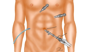 Placement of the drainage