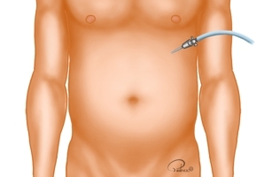 Establish pneumoperitoneum