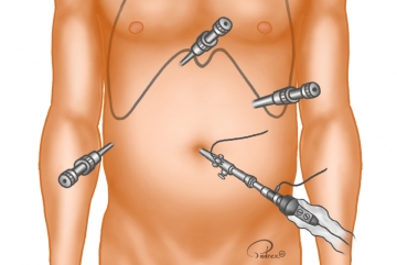 Trocar positioning