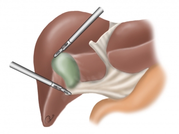 Exposing the gallbladder