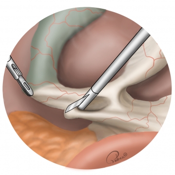 Dissecting Calot’s triangle