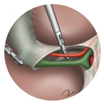 Exposing the cystic duct and cystic artery