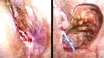 Inserting a silicone seton