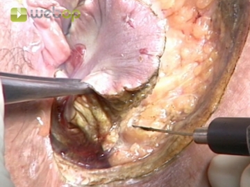 Dissecting the fistula from ischioanal fatty tissue