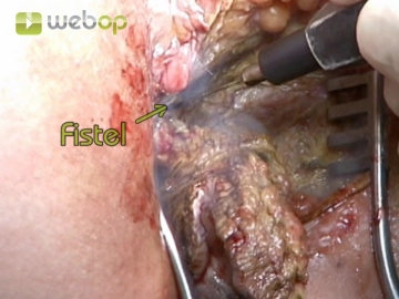 Excising the extrasphincteric segments of the fistula