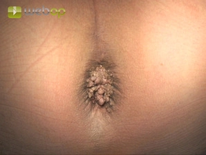 Definition; Pathophysiology