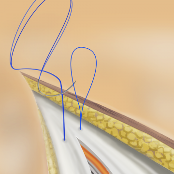 Continuous fascial closure with looped sutures; superior suture