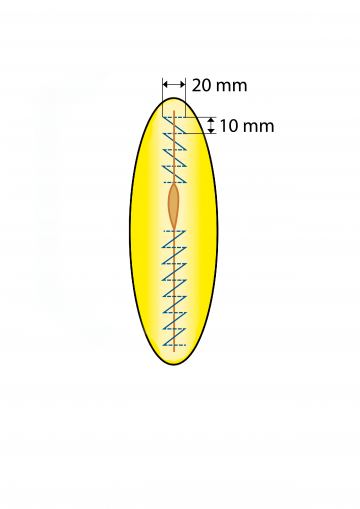 Continuous fascial closure with looped sutures; inferior suture