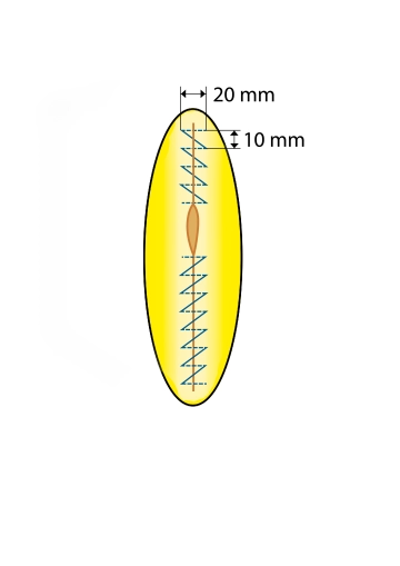 Continuous fascial closure with looped sutures; inferior suture