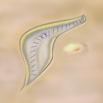 Continuous fascial closure with looped sutures; knotting technique