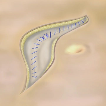 Continuous fascial closure with looped sutures; knotting technique