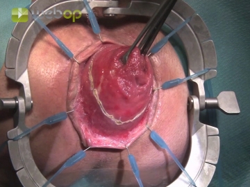 Inserting the anal retractor and incising the rectal wall
