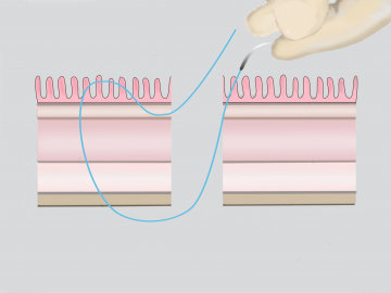 Transect the outer duplication of the rectal wall 