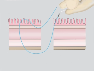 Transect the outer duplication of the rectal wall