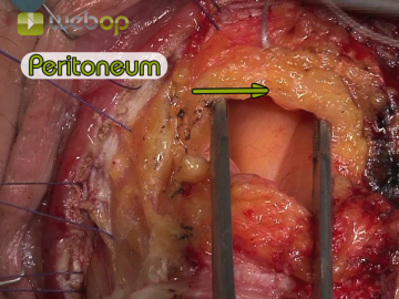 Opening the pouch of Douglas and transecting the lateral ligaments