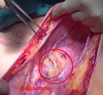 Incisión cutánea y apertura del saco herniario