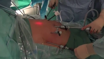 Accesses/Trocar Positions