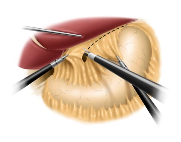 Incision of the lesser omentum and dissection of the right diaphragmatic crus