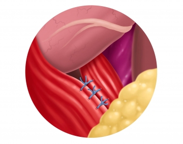 Posterior hiatoplasty