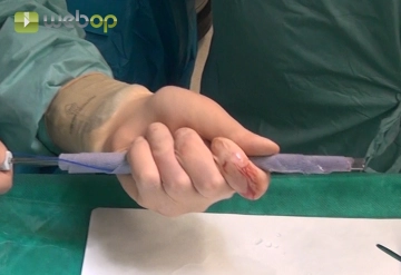 Insertion of the Mesh